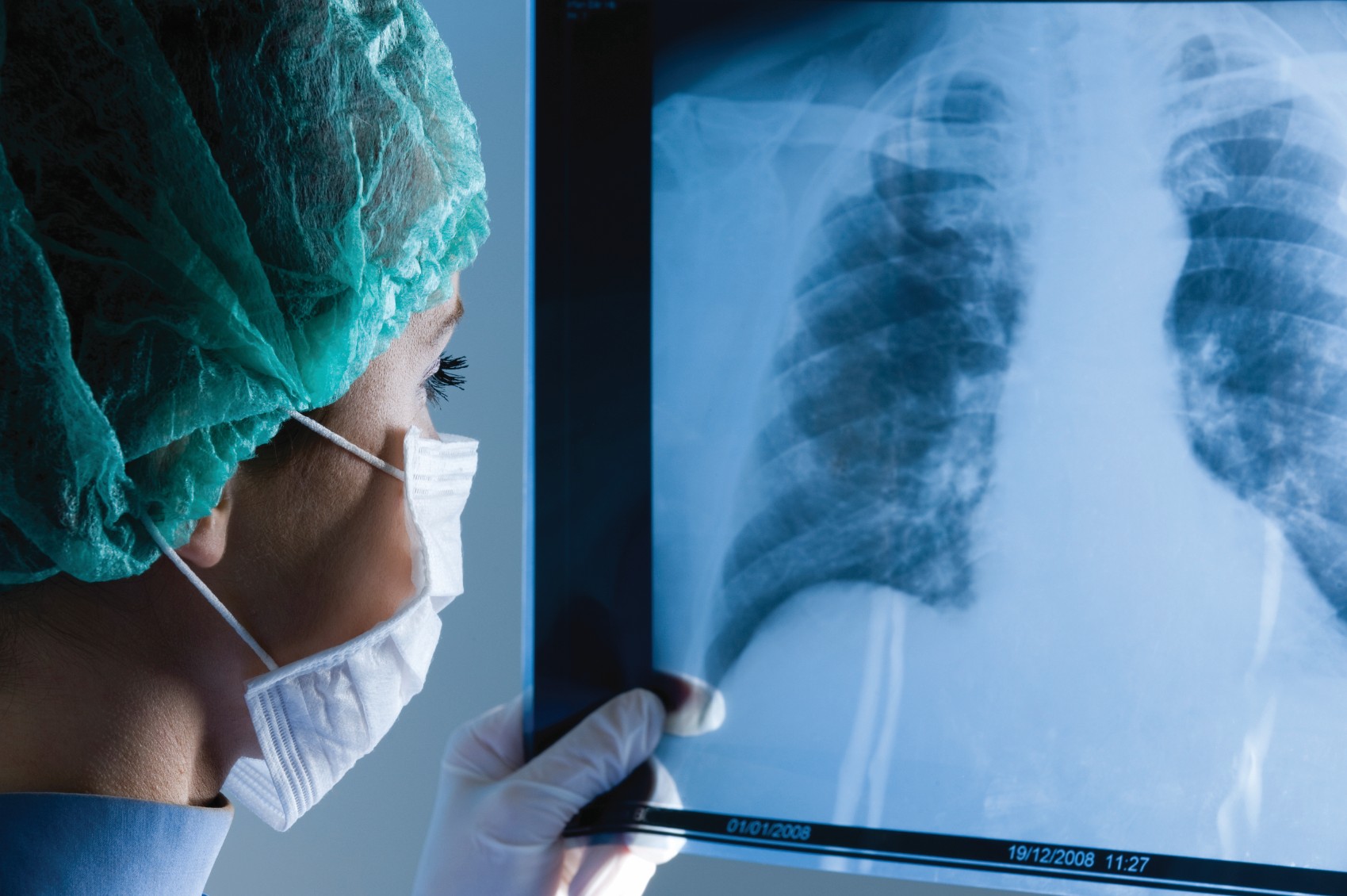 mesothelioma diagnosis